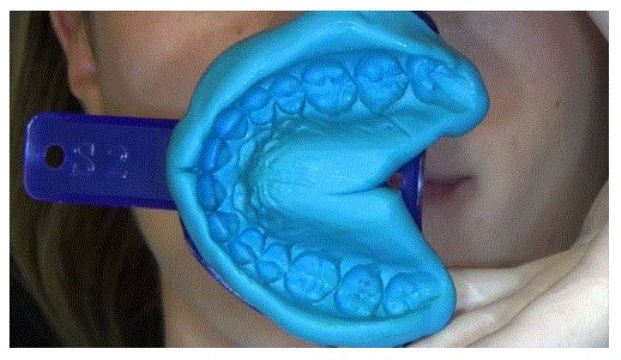 Dental Impression Silicone Mold Putty